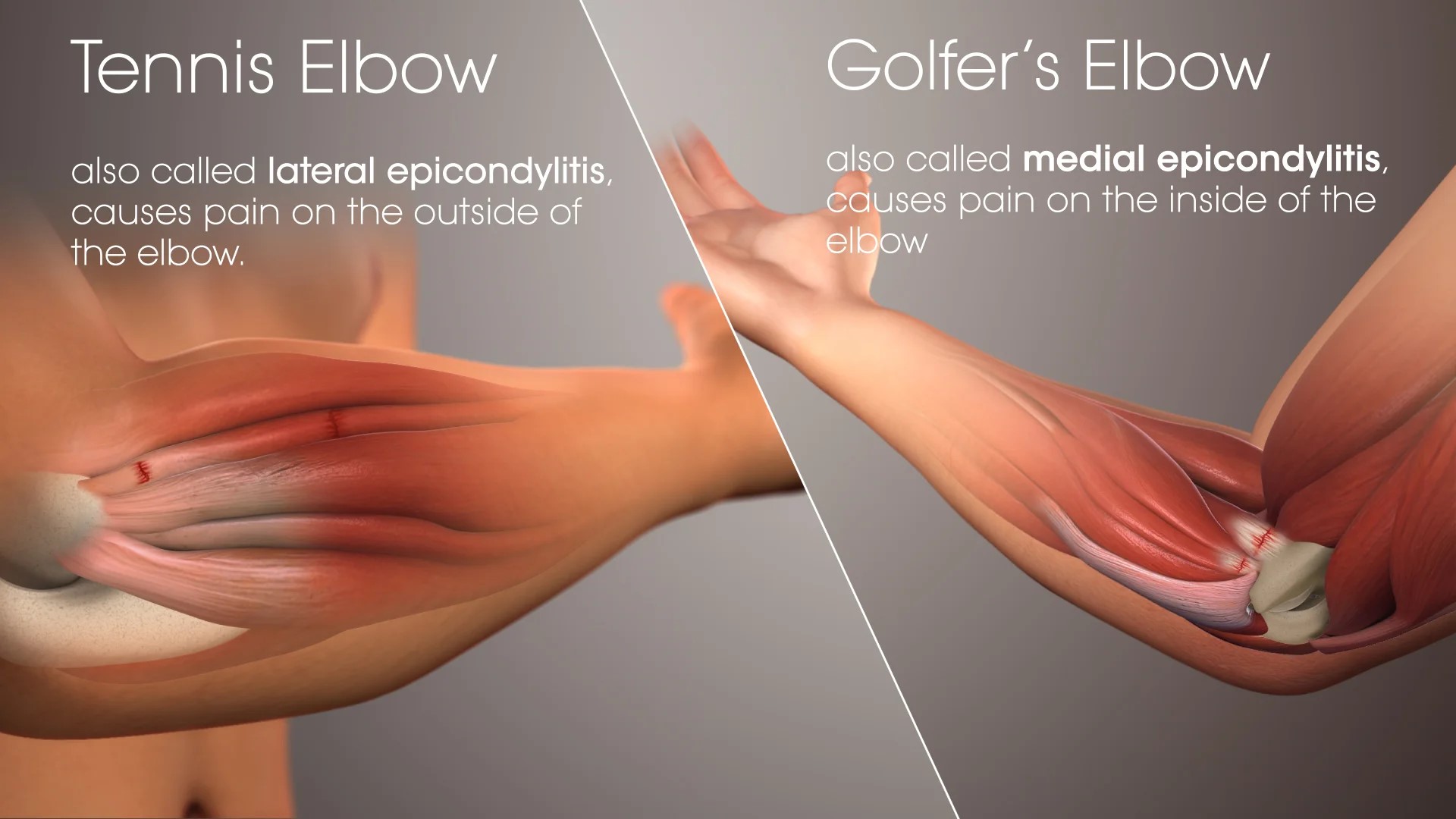 Tennis Elbow and Golfer's Elbow Treatment in Kathmandu: Non-Surgical Recovery for Desk Workers and Athletes